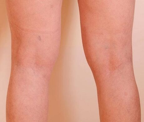 Varicone eliminated varicose veins