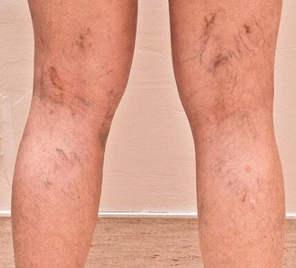 Varicose veins appeared on the legs. 