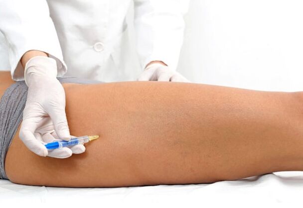 Treatment of varicose veins