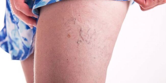 varicose veins in the leg