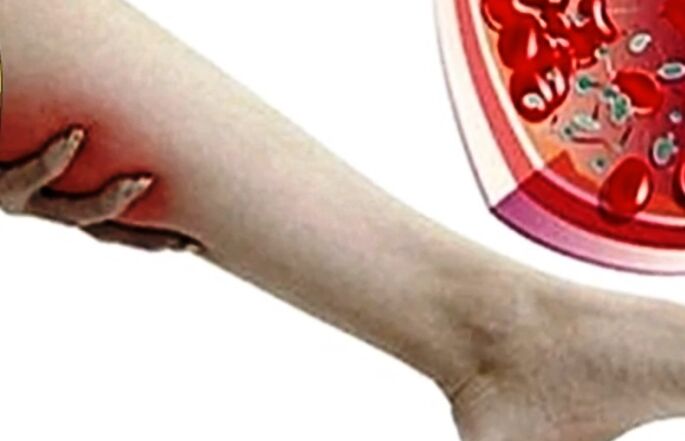 Varicose veins in the leg