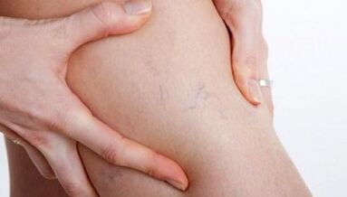 How are the varicose veins on the legs