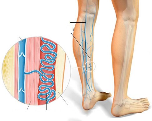 Clinical manifestations of varicose veins.