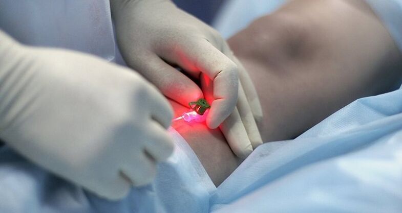 Surgical treatment of varicose veins.