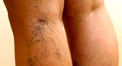 effective ways to treat varicose veins