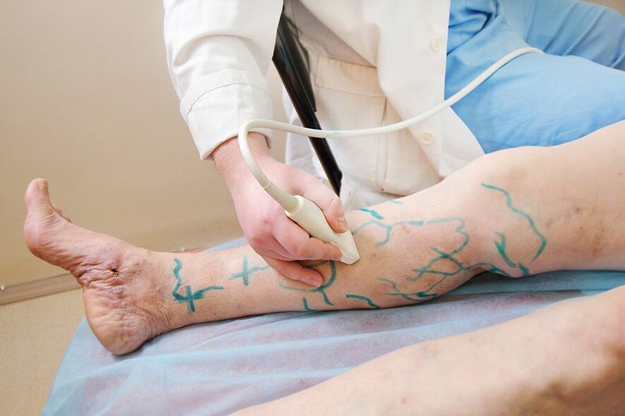 Preparation for miniphlebectomy, mark the leg perforators and perform an ultrasound