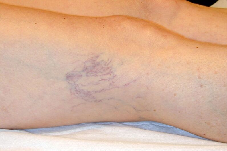 Stage C1 reticular veins with a diameter of about 1 mm