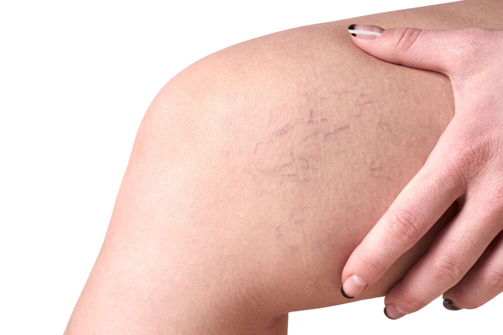 Stage C1 spider veins