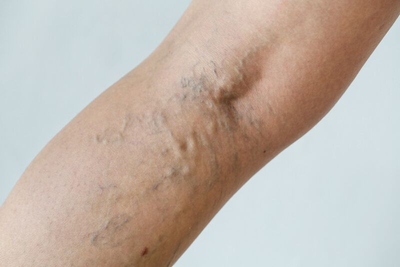 Stage C2 popliteal varicose veins (Thierry perforator) and reticular veins