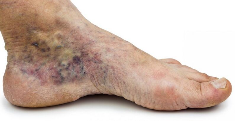 Stage C4c crown of foot, phlebitis in center