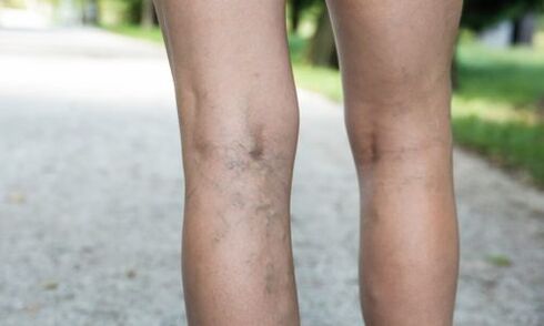 the appearance of venous veins, a symptom of varicose veins